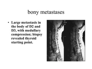 bony metastases Large metastasis in the body of D2 and D3, with medullary compression; biopsy revealed thyroid starting point.   