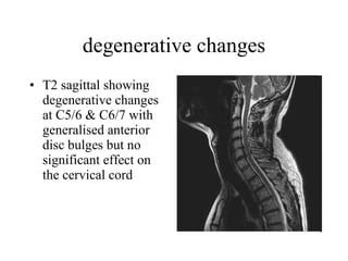 degenerative changes T2 sagittal showing degenerative changes at C5/6 & C6/7 with generalised anterior disc bulges but no significant effect on the cervical cord  
