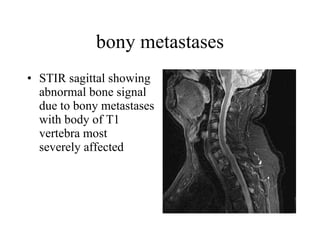 bony metastases STIR sagittal showing abnormal bone signal due to bony metastases with body of T1 vertebra most  severely affected  
