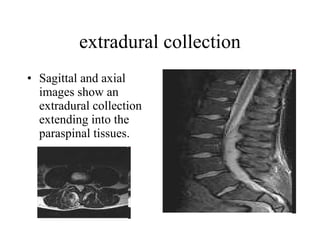 extradural collection Sagittal and axial images show an extradural collection extending into the paraspinal tissues.  