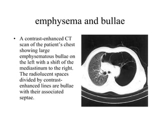 emphysema and bullae A contrast-enhanced CT scan of the patient’s chest showing large emphysematous bullae on the left with a shift of the mediastinum to the right. The radiolucent spaces divided by contrast-enhanced lines are bullae with their associated septae.  