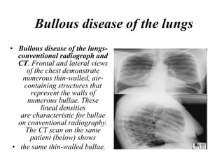 Bullous disease of the lungs Bullous disease of the lungs-conventional radiograph and CT . Frontal and lateral views of the chest demonstrate numerous thin-walled, air-containing structures that represent the walls of numerous bullae. These lineal densities are characteristic for bullae on conventional radiography. The CT scan on the same patient (below) shows the same thin-walled bullae. 
