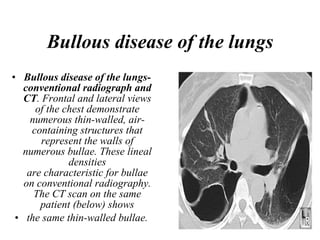Bullous disease of the lungs Bullous disease of the lungs-conventional radiograph and CT . Frontal and lateral views of the chest demonstrate numerous thin-walled, air-containing structures that represent the walls of numerous bullae. These lineal densities are characteristic for bullae on conventional radiography. The CT scan on the same patient (below) shows the same thin-walled bullae. 