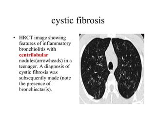 cystic fibrosis HRCT image showing features of inflammatory bronchiolitis with  centrilobular  nodules(arrowheads) in a teenager. A diagnosis of cystic fibrosis was subsequently made (note the presence of bronchiectasis).  
