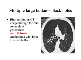 Multiple large bullae—black holes High resolution CT image through the mid zones show generalized  centrilobular  emphysema with large bilateral bullae.  