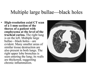 Multiple large bullae—black holes High-resolution axial CT scan of a 1-mm section of the thorax of a patient with emphysema at the level of the tracheal carina.  The right lung is on the left. Multiple large bullae—black holes—are evident. Many smaller areas of similar tissue destruction are also present in both lungs. The right upper lobe bronchus is seen entering the lung; its walls are thickened, suggesting chronic inflammation.  