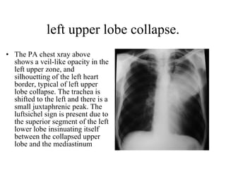 left upper lobe collapse. The PA chest xray above shows a veil-like opacity in the left upper zone, and silhouetting of the left heart border, typical of left upper lobe collapse. The trachea is shifted to the left and there is a small juxtaphrenic peak. The luftsichel sign is present due to the superior segment of the left lower lobe insinuating itself between the collapsed upper lobe and the mediastinum  