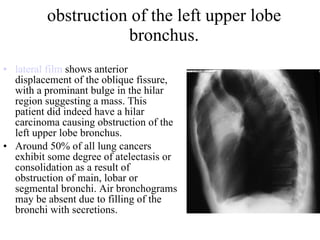 obstruction of the left upper lobe bronchus. lateral film  shows anterior displacement of the oblique fissure, with a prominant bulge in the hilar region suggesting a mass. This patient did indeed have a hilar carcinoma causing obstruction of the left upper lobe bronchus. Around 50% of all lung cancers exhibit some degree of atelectasis or consolidation as a result of obstruction of main, lobar or segmental bronchi. Air bronchograms may be absent due to filling of the bronchi with secretions. 