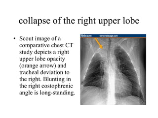 collapse of the right upper lobe Scout image of a comparative chest CT study depicts a right upper lobe opacity (orange arrow) and tracheal deviation to the right. Blunting in the right costophrenic angle is long-standing.  