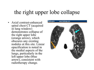 the right upper lobe collapse Axial contrast-enhanced spiral chest CT (acquired in lung window) demonstrates collapse of the right upper lobe (orange arrow), which obscures any existing nodules at this site. Linear opacification is noted in the medial aspects of the lungs, particularly in the left upper lobe (blue arrow), consistent with radiotherapy change.  
