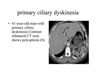 primary ciliary dyskinesia 41-year-old man with primary ciliary dyskinesia Contrast-enhanced CT scan shows polysplenia (S)  