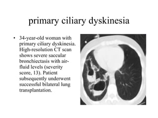 primary ciliary dyskinesia 34-year-old woman with primary ciliary dyskinesia. High-resolution CT scan shows severe saccular bronchiectasis with air-fluid levels (severity score, 13). Patient subsequently underwent successful bilateral lung transplantation.  