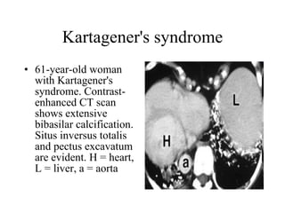 Kartagener's syndrome 61-year-old woman with Kartagener's syndrome. Contrast-enhanced CT scan shows extensive bibasilar calcification. Situs inversus totalis and pectus excavatum are evident. H = heart, L = liver, a = aorta  