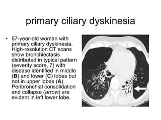 primary ciliary dyskinesia 57-year-old woman with primary ciliary dyskinesia. High-resolution CT scans show bronchiectasis distributed in typical pattern (severity score, 7) with disease identified in middle ( B ) and lower ( C ) lobes but not in upper lobes ( A ). Peribronchial consolidation and collapse ( arrow ) are evident in left lower lobe.   