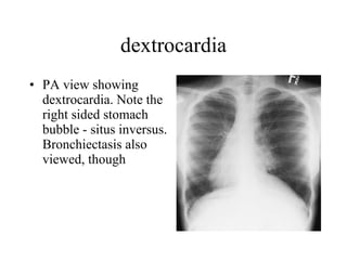 dextrocardia PA view showing dextrocardia. Note the right sided stomach bubble - situs inversus. Bronchiectasis also viewed, though  not easily appreciated on this film.  