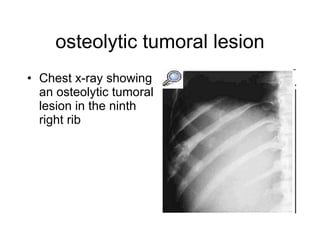 osteolytic tumoral lesion Chest x-ray showing an osteolytic tumoral lesion in the ninth right rib   