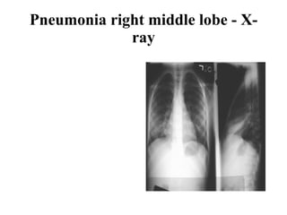 Pneumonia right middle lobe - X-ray 