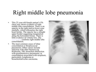 Right middle lobe pneumonia This 25 year-old female patient’s PA chest xray shows evidence of right middle lobe consolidation. There is an opacity in the right mid-to-lower zone medially, which silhouettes the right heart border. The opacity has a straight upper border suggesting margination along the horizontal fissure. There is little evidence of volume loss. The  lateral film  confirms right middle lobe consolidation. The most common cause of lobar consolidation is Streptococcal pneumonia. Other causes include infection with other bacteria (eg Klebsiella, TB); bronchial obstruction with postobstructive pneumonia; or consolidation associated with neoplasm, particularly lymphoma or bronchioloalveolar carcinoma. 
