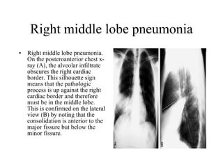 Right middle lobe pneumonia Right middle lobe pneumonia. On the posteroanterior chest x-ray (A), the alveolar infiltrate obscures the right cardiac border. This silhouette sign means that the pathologic process is up against the right cardiac border and therefore must be in the middle lobe. This is confirmed on the lateral view (B) by noting that the consolidation is anterior to the major fissure but below the minor fissure.  