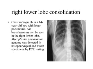 right lower lobe consolidation  Chest radiograph in a 14-year-old boy with lobar pneumonia. Air bronchograms can be seen in the right lower lobe.  Mycoplasma pneumoniae  genome was detected in nasopharyngeal and throat specimens by PCR testing.  