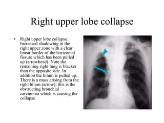 Right upper lobe collapse Right upper lobe collapse. Increased shadowing in the right upper zone with a clear linear border of the horizontal fissure which has been pulled up (arrowhead). Note the remaining right lung is blacker than the opposite side. In addition the hilum is pulled up. There is a mass arising from the right hilum (arrow); this is the obstructing bronchial carcinoma which is causing the collapse  