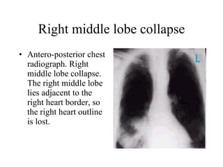 Right middle lobe collapse Antero-posterior chest radiograph. Right middle lobe collapse. The right middle lobe lies adjacent to the right heart border, so the right heart outline is lost.  