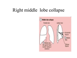 Right middle  lobe collapse 