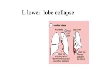 L lower  lobe collapse 