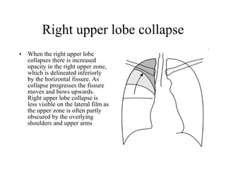 Right upper lobe collapse When the right upper lobe collapses there is increased opacity in the right upper zone, which is delineated inferiorly by the horizontal fissure. As collapse progresses the fissure moves and bows upwards. Right upper lobe collapse is less visible on the lateral film as the upper zone is often partly obscured by the overlying shoulders and upper arms  