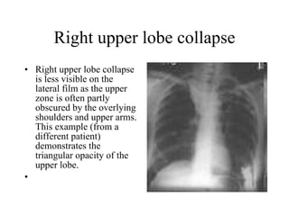 Right upper lobe collapse Right upper lobe collapse is less visible on the lateral film as the upper zone is often partly obscured by the overlying shoulders and upper arms. This example (from a different patient) demonstrates the triangular opacity of the upper lobe.  