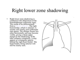 Right lower zone shadowing Right lower zone shadowing is combined with obliteration of the hemidiaphragm (silhouette sign). This needs to be differentiated from a  pleural effusion . The right heart border, which is anterior, is usually still clearly seen (silhouette sign again). The oblique fissure lies more horizontally and may become visible, giving a sharp upper margin to the shadowing. If the lobe collapses completely, it may appear as a triangular opacity behind the right heart border. The heart border, being anterior will still be clearly seen.  