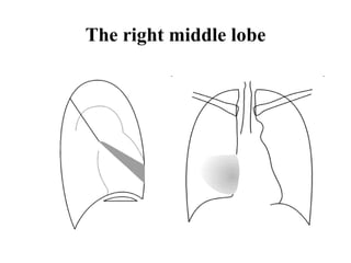 The right middle lobe 