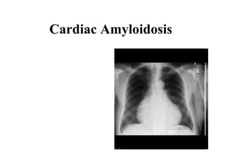 Cardiac Amyloidosis   