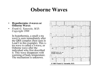 Osborne Waves Hypothermia: J-waves or Osborne Waves Frank G. Yanowitz, M.D. Copyright 1998  In hypothermia, a small x-tra wave is seen immediately after the QRS complex (best seen in Lead I in this example). This x-tra wave is called a J-wave, or Osborne wave after the individual who first described it. This wave disappears with warming of body temperature. The mechanism is unknown.  