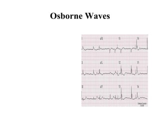 Osborne Waves 