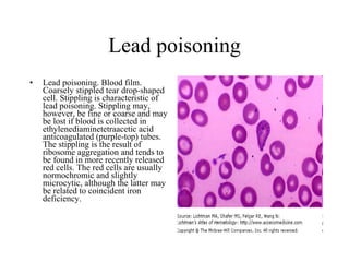 Lead poisoning Lead poisoning. Blood film. Coarsely stippled tear drop-shaped cell. Stippling is characteristic of lead poisoning. Stippling may, however, be fine or coarse and may be lost if blood is collected in ethylenediaminetetraacetic acid anticoagulated (purple-top) tubes. The stippling is the result of ribosome aggregation and tends to be found in more recently released red cells. The red cells are usually normochromic and slightly microcytic, although the latter may be related to coincident iron deficiency.  