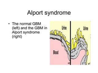 Alport syndrome The normal GBM (left) and the GBM in Alport syndrome (right)   