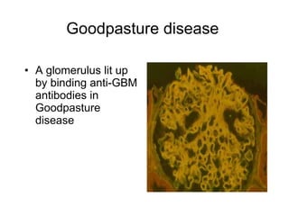 Goodpasture disease   A glomerulus lit up by binding anti-GBM antibodies in Goodpasture disease   