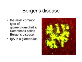 Berger's disease the most common type of glomerulonephritis. Sometimes called Berger's disease.  IgA in a glomerulus  