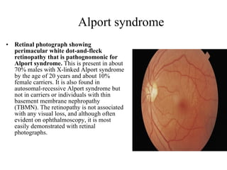 Alport syndrome Retinal photograph showing perimacular white dot-and-fleck retinopathy that is pathognomonic for Alport syndrome.  This is present in about 70% males with X-linked Alport syndrome by the age of 20 years and about 10% female carriers. It is also found in autosomal-recessive Alport syndrome but not in carriers or individuals with thin basement membrane nephropathy (TBMN). The retinopathy is not associated with any visual loss, and although often evident on ophthalmoscopy, it is most easily demonstrated with retinal photographs.  