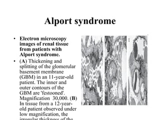 Alport syndrome Electron microscopy images of renal tissue from patients with Alport syndrome. ( A ) Thickening and splitting of the glomerular basement membrane (GBM) in an 11-year-old patient. The inner and outer contours of the GBM are 'festooned'. Magnification  30,000. ( B ) In tissue from a 12-year-old patient observed under low magnification, the irregular thickness of the GBM is evident. Magnification  5,400. ( C ) Diffuse thinning of the GBM in a 3-year-old male patient. Magnification  6,200. All sections stained with uranyl acetate and lead citrate. 