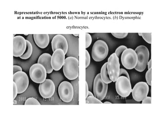 Representative erythrocytes shown by a scanning electron microsopy at a magnification of 5000.  ( a ) Normal erythrocytes. ( b ) Dysmorphic erythrocytes.   
