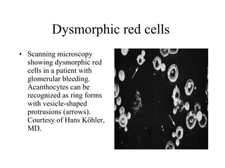 Dysmorphic red cells  Scanning microscopy showing dysmorphic red cells in a patient with glomerular bleeding. Acanthocytes can be recognized as ring forms with vesicle-shaped protrusions (arrows). Courtesy of Hans Köhler, MD.  