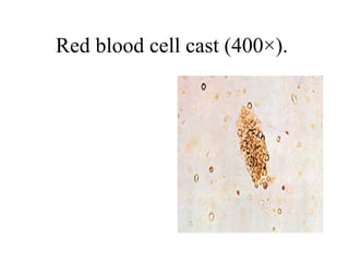 Red blood cell cast (400×).  