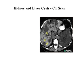 Kidney and Liver Cysts - CT Scan 