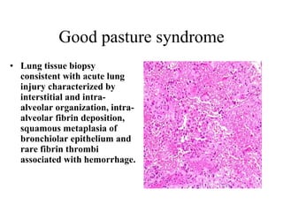 Good pasture syndrome Lung tissue biopsy consistent with acute lung injury characterized by interstitial and intra-alveolar organization, intra-alveolar fibrin deposition, squamous metaplasia of bronchiolar epithelium and rare fibrin thrombi associated with hemorrhage.  