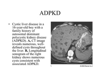 ADPKD Cystic liver disease in a 16-year-old boy with a family history of autosomal dominant polycystic kidney disease (ADPKD).  A,  CT image reveals numerous, well-defined cysts throughout the liver.  B,  Longitudinal sonogram of the right kidney shows numerous cysts consistent with associated ADPKD.  