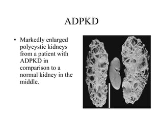 ADPKD Markedly enlarged polycystic kidneys from a patient with ADPKD in comparison to a normal kidney in the middle.  
