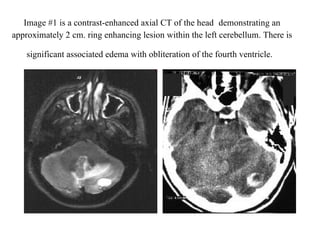 Image #1 is a contrast-enhanced axial CT of the head   demonstrating an approximately 2 cm. ring enhancing lesion within the left cerebellum. There is significant associated edema with obliteration of the fourth ventricle.   