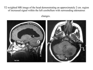 T2 weighted MR image of the head demonstrating an approximately 2 cm. region of increased signal within the left cerebellum with surrounding edematous changes.   